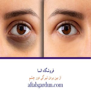 درمان تیرگی دور چشم | محصولات پوستی | السا